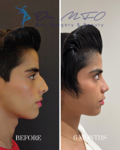 Before and after side profile comparison of a patient's nose surgery results by Dr. MFO, showing the nose 6 months post-operation.