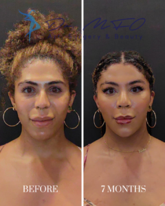 Before and after facial procedure results showing a patient before and seven months after the treatment, provided by Dr. MFO Surgery & Beauty.