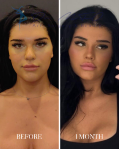 Before and after comparison of a patient's face, showing results one month after a cosmetic procedure by Dr. MFO.