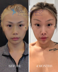 Before and after comparison of a patient's face after cosmetic procedure by Dr. MFO, showing results after 4 months.