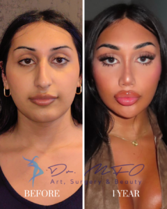 Before and after comparison of a patient's facial aesthetic transformation, one year after surgery by Dr. MFO, showing improvements in facial contours and features.