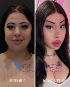 Before and after plastic surgery results showing a patient's facial transformation after 10 months, presented by Dr. MFO Art, Surgery & Beauty.
