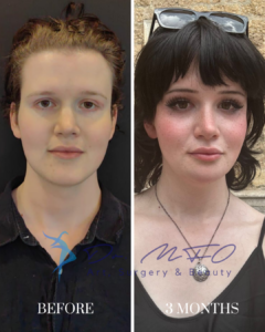 Before and 3 months after plastic surgery comparison showing a patient's facial aesthetic enhancement by Dr. MFO Surgery & Beauty.
