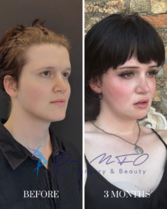 Before and after facial cosmetic surgery transformation showing a patient at three months post-operation.