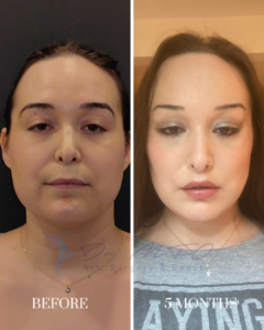 Before and after comparison of a woman's face after facial plastic surgery, showing results after 5 months.