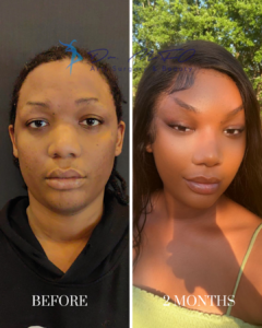 A side-by-side comparison of a patient before and two months after plastic surgery by Dr. MFO Art Surgery & Beauty.