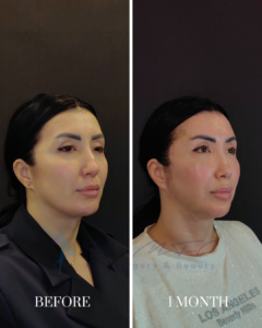 Before and after comparison of a woman's facial rejuvenation treatment, showing the results one month after the procedure.