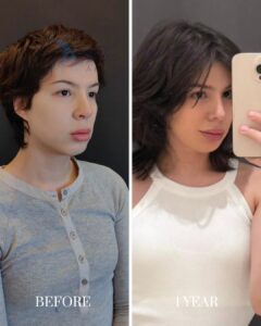 A side-by-side comparison of a woman's face before and one year after plastic surgery, showing facial rejuvenation results.