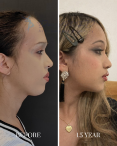 Side-by-side comparison of a patient's facial profile before and 1.5 years after cosmetic surgery, showing improved chin and jawline definition.