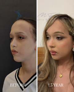 Before and after plastic surgery comparison showing a patient's facial profile transformation over 1.5 years.