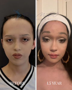 Before and after transformation of a patient's facial features 1.5 years after a surgical procedure by Dr. MFO Art Surgery & Beauty.