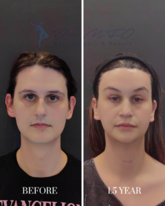 Before and after facial transformation result from Dr. MFO, showing a patient's appearance before treatment and 1.5 years later.
