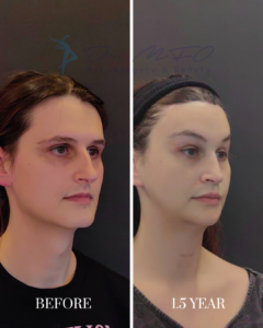 Before and after facial rejuvenation surgery results, showing a patient's face from a side profile perspective at baseline and 1.5 years post-operation, performed by Dr. MFO.