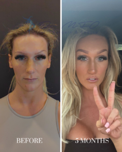 A before and after facial transformation comparison showing a woman's progress five months after cosmetic surgery.
