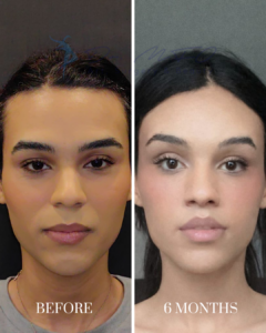 Before and after comparison of a patient's facial aesthetic results, showing the improvement six months after a plastic surgery procedure.