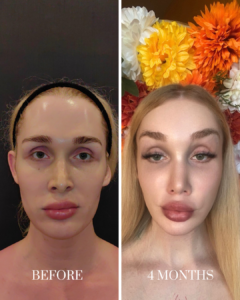 Before and after comparison of a woman's face, showing results 4 months after a cosmetic procedure, with 'BEFORE' and '4 MONTHS' text labels.