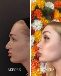 Side-profile comparison of a patient before and 4 months after rhinoplasty surgery, showing improved nasal contours.