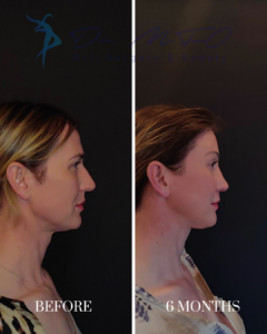 Side profile view of a patient before and six months after a plastic surgery procedure, showing facial rejuvenation.