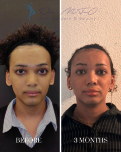 Before and 3 months after aesthetic surgery results of a patient, showing facial transformation.