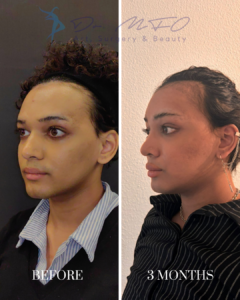 A side-by-side comparison showing the before and 3-month post-procedure results of facial feminization surgery by Dr. MFO.