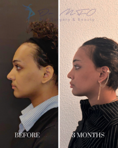 Side profile view of a patient before and 3 months after a cosmetic procedure, showing facial aesthetic results.