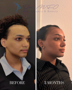 Before and after facial procedure results showing a patient's transformation after 3 months, presented by Dr. MFO Art, Surgery & Beauty.