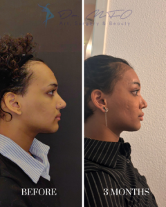 Before and 3 months after profile view of a patient's rhinoplasty procedure performed by Dr. MFO, Art, Surgery & Beauty.