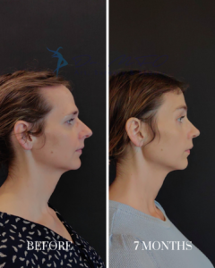 Side profile comparison of a woman's facial results before and seven months after cosmetic surgery, showing a more defined jawline and refined nose.