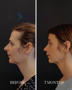 Before and 7 months after rhinoplasty results, showing a side profile comparison of a woman's nose and facial contour.