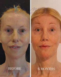 Before and after comparison of a woman's facial rejuvenation results 6 months post-procedure, showing improved skin texture and restored facial volume by Dr. MFO Art, Surgery & Beauty.