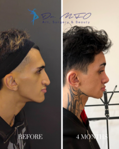 Before and after profile view of a patient's rhinoplasty surgery results by Dr. MFO, showing the nose transformation at 4 months post-operation.