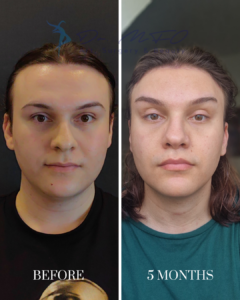 A side-by-side before and after comparison of a person's face 5 months after facial surgery, showing a lowered hairline, smoother forehead, and refined facial contours. The image is branded with the Dr. MFO Plastic Surgery & Beauty logo.