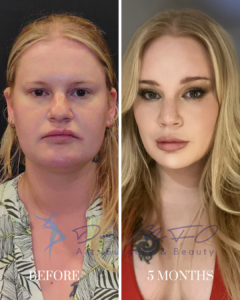 Before and after photo showing the facial transformation of a blonde woman 5 months after rhinoplasty and lip fillers by Dr. MFO Art, Surgery & Beauty.