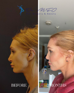 Before and after side profile comparison of a woman's facial rejuvenation results two months after surgery by Dr. MFO Art, Surgery & Beauty, showing a more defined jawline and neck.