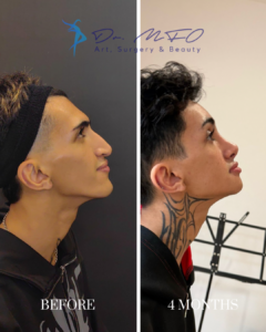 Before and 4 months after rhinoplasty surgery showing the profile view of a male patient.