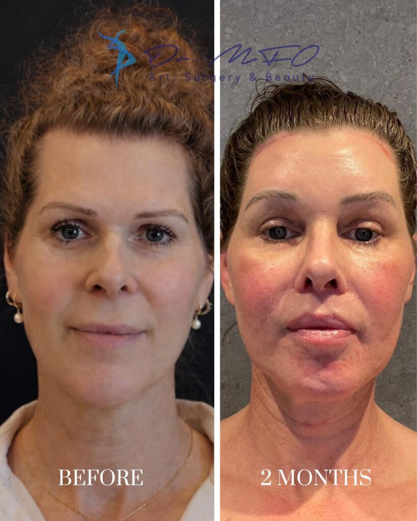 Facial Feminization