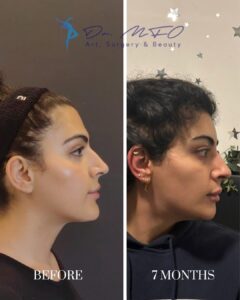 A side-by-side comparison image showing the profile view of a person's face before and seven months after a cosmetic procedure. The left side is labeled 'BEFORE' and the right side is labeled '7 MONTHS,' highlighting changes in the nasal structure and overall facial profile. The logos and text 'Dr. MFO Art, Surgery & Beauty' are visible in the top corners.