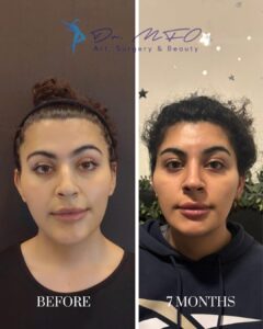 A side-by-side comparison photo showing a woman's face before and seven months after a cosmetic procedure. The left image is labeled 'BEFORE' and the right image is labeled '7 MONTHS,' highlighting changes in her facial features over time.