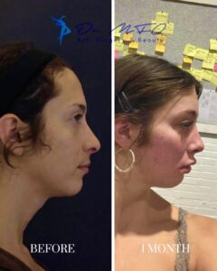 A side-by-side comparison image showing the profile of a person before and one month after a cosmetic procedure. The left side, labeled 'BEFORE,' displays a clear profile view of the person's face. The right side, labeled '1 MONTH,' shows the same profile with visible signs of healing, including redness and swelling. The background includes branding for a clinic specializing in art, surgery, and beauty.