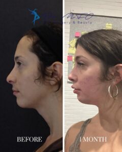 A side-by-side comparison image showing the profile view of a woman's face before and one month after a cosmetic procedure. The left side, labeled 'BEFORE,' displays the initial appearance, while the right side, labeled '1 MONTH,' shows the results one month post-procedure. The logo and text 'Dr. MFO Art, Surgery & Beauty' are visible in the top right corner.