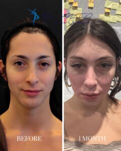 A side-by-side comparison image showing a woman's face before and one month after a cosmetic procedure. The left side, labeled 'BEFORE,' depicts the woman's face prior to the procedure, while the right side, labeled '1 MONTH,' shows her face one month post-procedure, highlighting changes in her appearance.