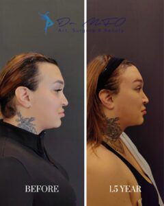 A side-by-side comparison image showing the profile view of an individual before and 1.5 years after a cosmetic procedure. The left side, labeled 'BEFORE,' displays the person's profile with a visible neck and chin area. The right side, labeled '1.5 YEAR,' shows the same individual's profile post-procedure, highlighting changes in the neck and jawline contour. Both images feature a tattoo of a rose on the side of the neck.
