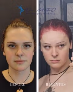 Феминизация лица