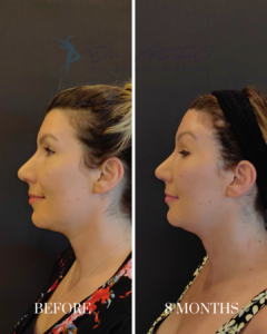 A side-by-side comparison showing a patient's profile before and 8 months after a cosmetic procedure, demonstrating facial rejuvenation and jawline enhancement.