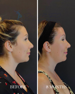 Before and 8 months after cosmetic procedure comparison showing profile view of a woman's face and neck, highlighting aesthetic improvements.