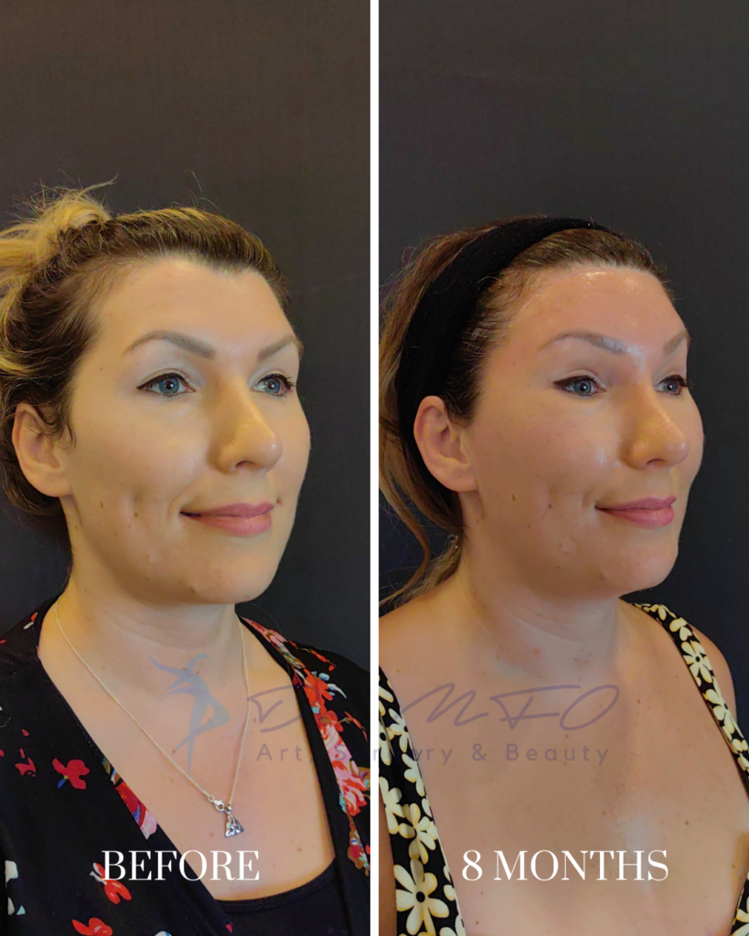 Cheekbone Contouring