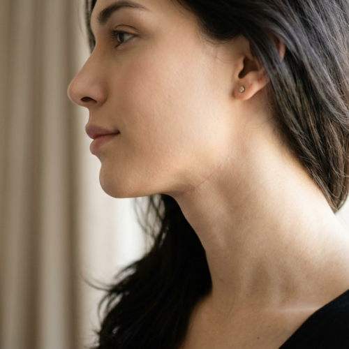 Ein hochauflösendes, hyperrealistisches Porträt, aufgenommen mit einem 85-mm-Porträtobjektiv, zeigt eine junge Frau im Profil. Die Komposition nutzt weiches, natürliches Seitenlicht, das ihre Gesichtszüge und die glatte Hautstruktur sanft beleuchtet und die dezente, saubere Narbe nach einer Operation an ihrem Hals mit klinischer Präzision hervorhebt. Ihr Blick ist ruhig und nachdenklich, sie wendet den Blick von der Kamera ab. Der Fokus liegt scharf auf ihrer Kieferpartie und ihrem Hals und betont ihre natürliche Anatomie, während der Hintergrund eine weiche, unscharfe, neutrale Interieurkulisse darstellt, die eine klare, professionelle und ruhige Ästhetik erzeugt. Sie trägt ein schlichtes, dunkles, mattes Kleidungsstück, das einen minimalistischen Kontrast zur hellen, weichgezeichneten Umgebung bildet.