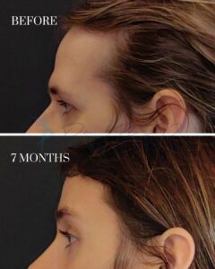 A side-by-side comparison image showing the profile view of a person's forehead, hairline, and ear before and after a procedure. The top image is labeled 'BEFORE,' depicting a higher hairline and a more pronounced forehead. The bottom image is labeled '7 MONTHS,' showing noticeable changes with a lower hairline and a more balanced forehead appearance.