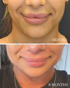 Chin Contouring
