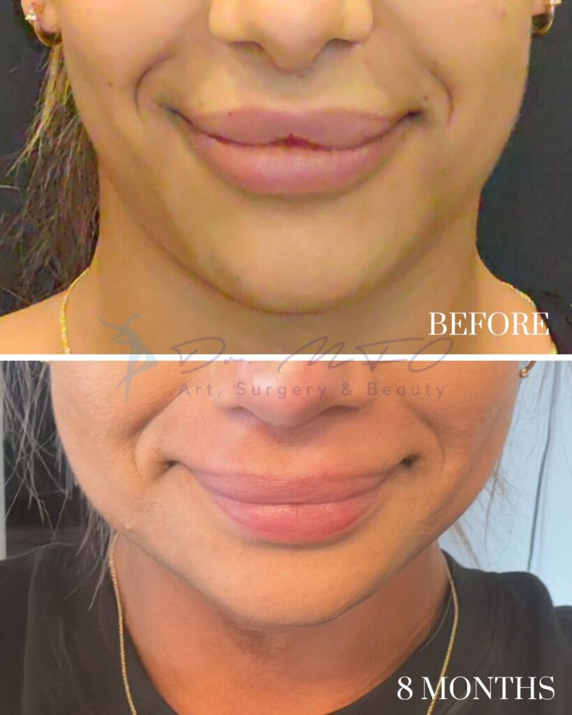 Chin Contouring